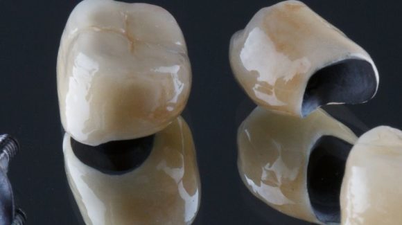 Crown and Bridge: Ideal Option for Natural-Looking Tooth Replacement