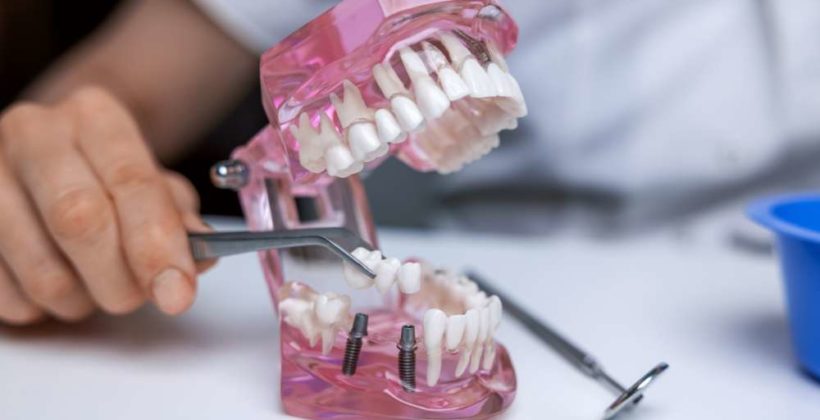 Dental bridges vs. implants