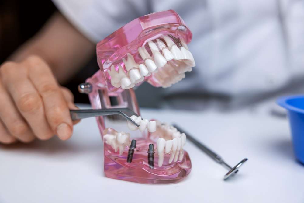 Dental bridges vs. implants