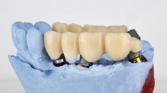 What is a Bridge in Dentistry? An Introduction to Dental Bridges