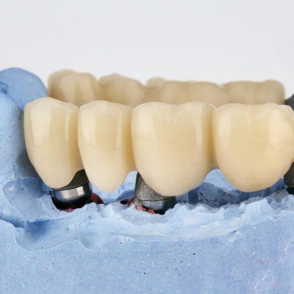 What is a Bridge in Dentistry? An Introduction to Dental Bridges