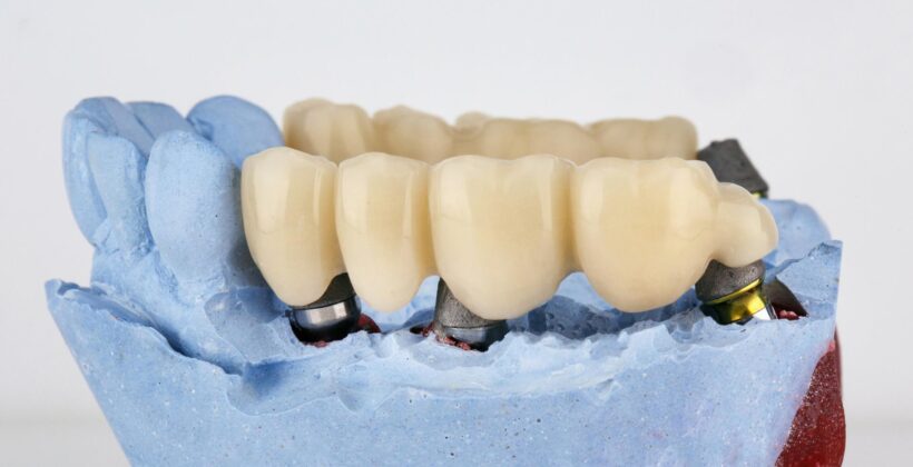 what is a bridge in dentistry? Midland dental explains