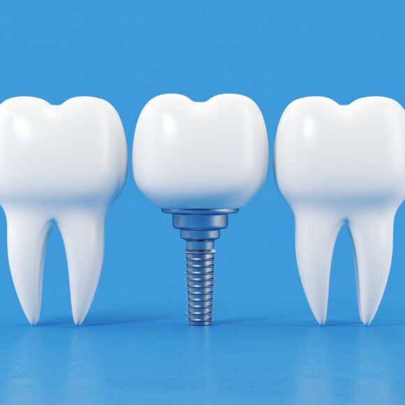 Trusted Dental Implants in Ontario for Lasting Oral Health