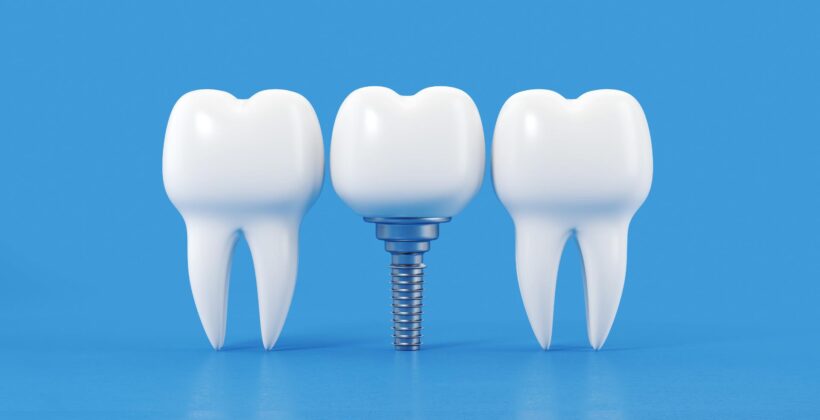 Dental implants in Ontario from Midland Bay