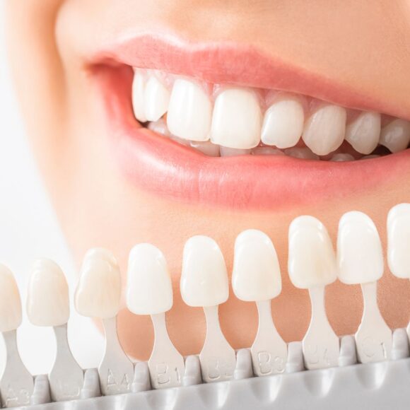 Brighten Your Smile with Teeth Whitening in Midland