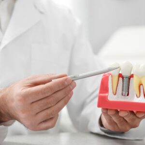 The Ultimate Guide to Dental Implants in Midland: What to Expect and How to Prepare