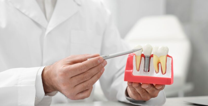 The Ultimate Guide to Dental Implants in Midland: What to Expect and How to Prepare